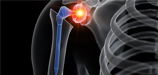 Schulterprothese: Nach zweijähriger Nachbeobachtung waren schaftlose Endoprothesen des Schultergelenks den Schaftprothesen nicht unterlegen, nicht mit Blick auf die Sicherheit und nicht hinsichtlich der Effektivität.
