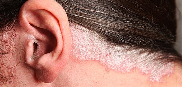 Mehr Aufklärung bei Psoriasis nötig! Schuppenflechte: Während Deutschland in der Versorgung von Psoriasis-Patienten vielen anderen Ländern weit vorau ist, gibt es in Sachen Aufklärung noch großen Nachholbedarf.