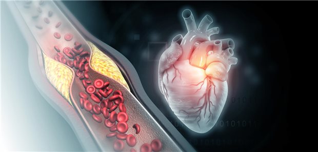 Abbildung Herzgefäße mit Atherosklerose