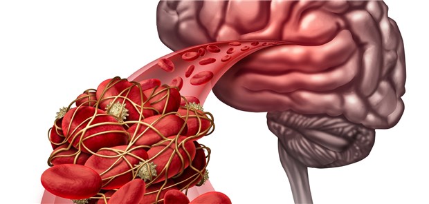 Schutz vor Thromboembolien durch NOAK: Die Autoren einer aktuellen Metaanalyse warnen vor Dosismodifikationen, die nicht den Zulassungen und den Leitlinien entsprechen.