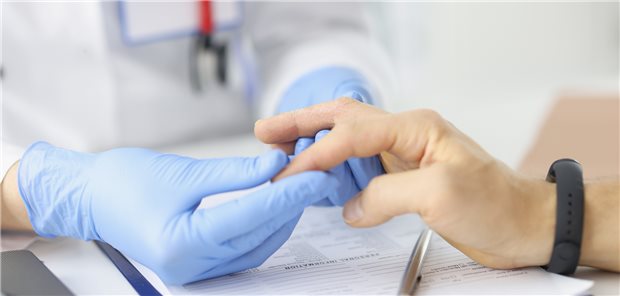Schwellung des Fingers bei einem Psoriasis-Patienten: Spricht eher für eine Psoriasisarthritis als für eine Arthrose.