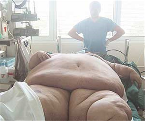 Magen-Bypass bringt die ganze Familie zum Abspecken Schwere Adipositas: Wird Patienten ein Magen-Bypass gelegt, nehmen daraufhin auch die Angehörigen des Operierten ab, zeigte eine US-Studie.