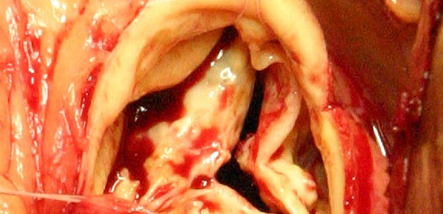 TAVI so gut wie Op Schwere Aortenklappenstenose. Ihre Behandlung ist heute nicht mehr ausschließlich eine Angelegenheit von Herzchirurgen.