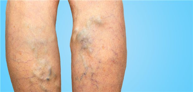 Schwere Beine und Überempfeindlichkeit gegen Kälte sind mit einem hohen Varikosis-Risiko assoziiert. (Symbolbild)