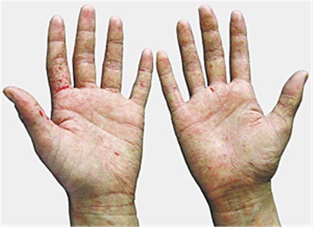 Berufsdermatose - meist trifft es die Hände Schwere Ekzeme mit Rissen und Verhornungen an der Handfläche.