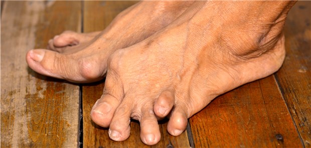 Schwere Fußdeformitäten können allenfalls mit großem Aufwand operativ korrigiert werden.