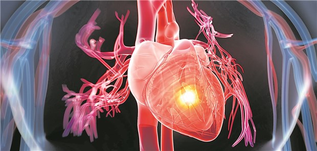 Schwere Psoriasis in jungen Jahren verdoppelt das Risiko für einen Herzinfarkt.