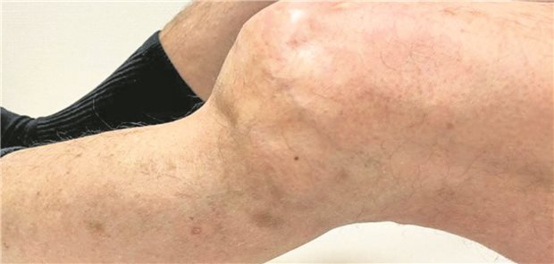 Schwere hämophile Arthropathie mit Gelenkdeformität und deutlich eingeschränkter Mobilität bei einem Patienten mit schwerer Hämophilie A: Mit neuen Medikamenten sollen so schwere Auswirkungen der Hämophilie besser verhindert werden, als das bisher möglich war. 