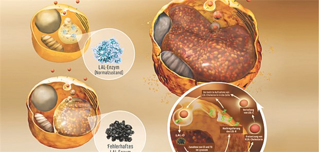 Sebelipase alfa übernimmt die Katalysefunktion der lysosomalen sauren Lipase (LAL): Cholesterinester (CE) und Triglyzeride (TG) werden abgebaut und freies Cholesterin (FC) und freie Fettsäuren (FFS) in der Zelle freigesetzt.