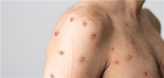 Sechs deutsche medizinisch-wissenschaftliche Fachgesellschaften fordern rasches und konsequentes Handeln gegen den Ausbruch von Infektionen mit Affenpockenviren (Symbolbild). 