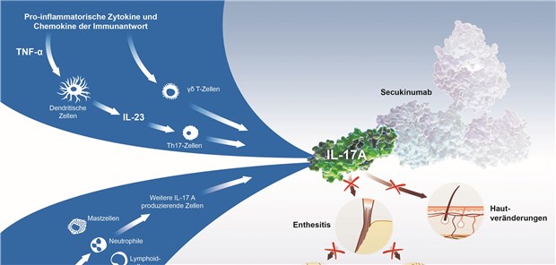 Secukinumab blockiert Interleukin (IL)-17A am Ort der Entzündung und greift somit direkt in das Krankheitsgeschehen der ankylosierenden Spondylitis sowie der Psoriasis-Arthritis und Plaque-Psoriasis ein. NOVARTIS