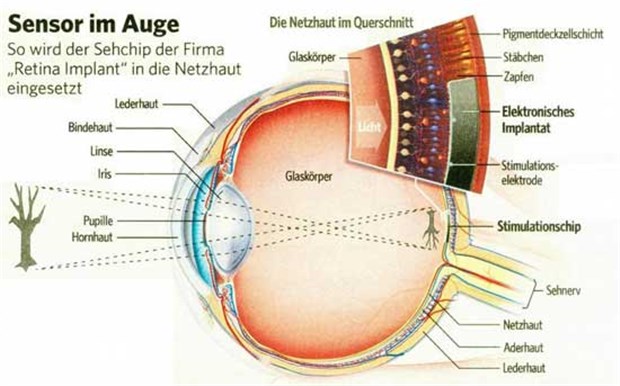 Neuer Netzhaut-Mikrochip bietet Hoffnugsschimmer für Patienten Sehchip der Firma Retina Implant in der Netzhaut.