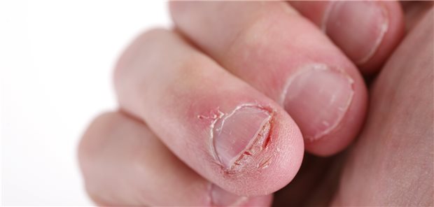 Bis(s) auf die Knochen Seit Kindertagen kaut der Patient an den Fingernägeln (Symbolbild).