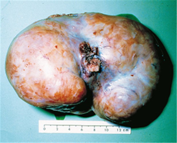 Bei Ovarial-Ca sind sorgfältige Op plus Chemo das A & O Sektionspräparat eines Ovarialkarzinoms. Solche Malignome befinden sich bei der Diagnose meist in fortgeschrittenen Stadien.