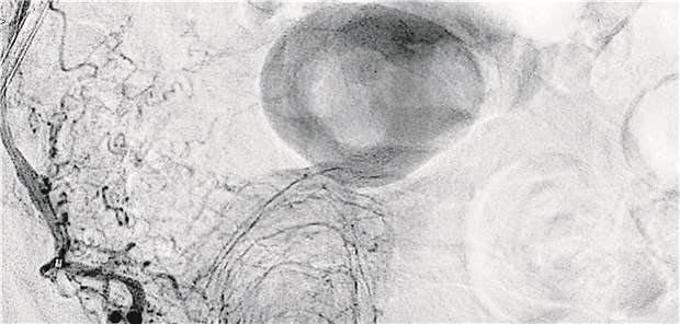 Selektive Angiografie des rechten Prostatalappens vor Prostatic Artery Embolization.