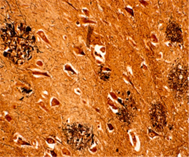 Rote Farbe entschärft Alzheimer-Plaques Senile Plaques in der Mikroaufnahme: Das Gehirn eines Alzheimer-Erkrankten.