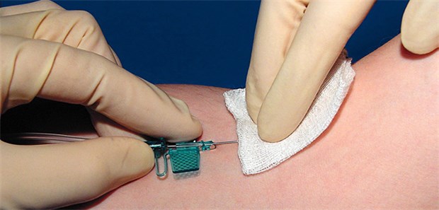 Tropenmediziner geben Tipps zur Diagnostik Serum oder Plasma ist für die PCR zur Zika-Diagnostik nötig.