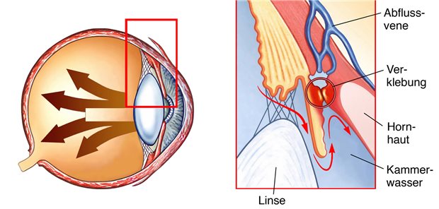 Siar Niazi und sein Team schlussfolgern aus den Studienergebnissen, dass die Behandlung mit einem GLP-1-Agonisten bei Diabeteskranken (insbesondere auch bei Adipösen) sinnvoll sein könnte, um die Entwicklung eines Glaukoms zu verhindern, gegebenenfalls auch zusätzlich zum Einsatz von Augentropfen zur Senkung des intraokulären Drucks.