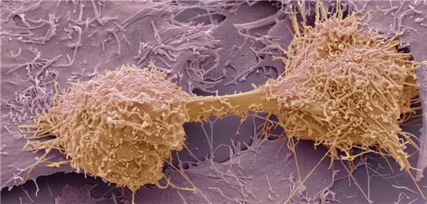 Sich teilende Leberkrebszelle (Rasterelektronenmikroskop).