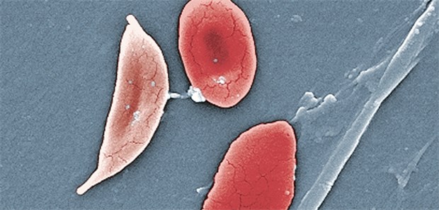 Sichelzellen: Innerhalb lokaler Neugeborenen-Screening-Projekte in Deutschland wurde eine Prävalenz der homozygoten Sichelzellanämie von 1:2500–1:12500 festgestellt.