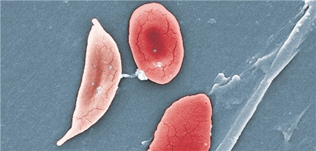Sichelzellen unter dem Rasterelektronenmikroskop.