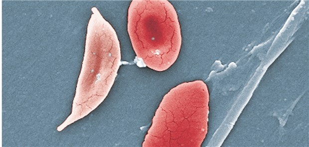 Sichelzellen unter dem Rasterelektronenmikroskop: Das pathologische Hämoglobin S verändert die Form der Erythrozyten.