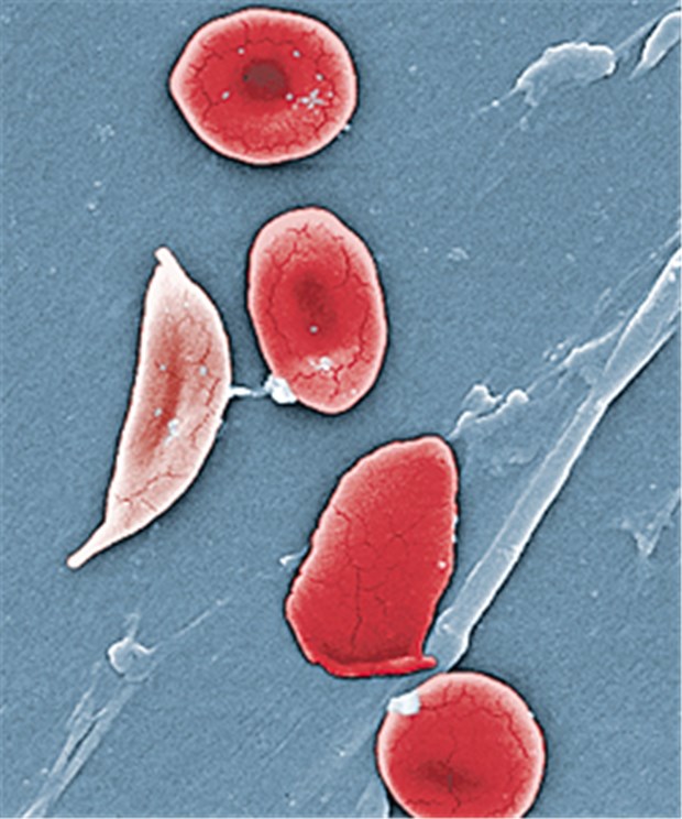 Neugeborene auf Sichelzellanämie screenen! Sichelzellen unter dem Rasterelektronenmikroskop: Das pathologische Hämoglobin S verändert die Form der Erythrozyten.