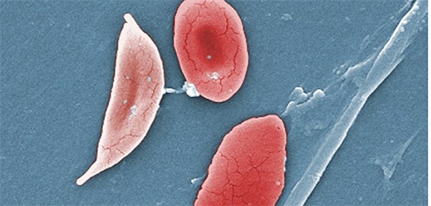Erfolg mit Gentherapie Sichelzellen unter dem Rastrelektronenmikroskop: Das pathologische Hämoglobin S verändert die Form der Erythrozyten.