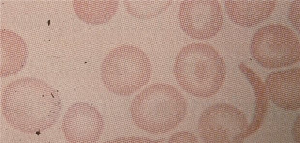 Sichelzellkrankheit (Blutbild): Akute Schmerzkrisen sind neben der Anämie das Leitsymptom.