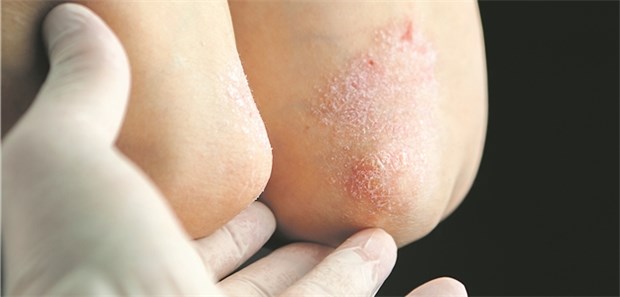 Sichtbare Hautveränderungen als Stigma? Psoriasis löst bei Patienten nicht selten großen Gesprächsbedarf aus.