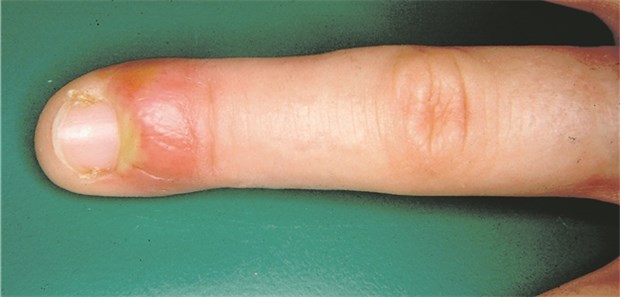 Sieht nach wenig aus, kann aber fies weh tun: Ein eitriger Fingernagelbett-"Umlauf". Er erfordert ähnlich wie ein eingewachsener Nagel gelegentlich sogar einen kleinen chirurgischen Eingriff.