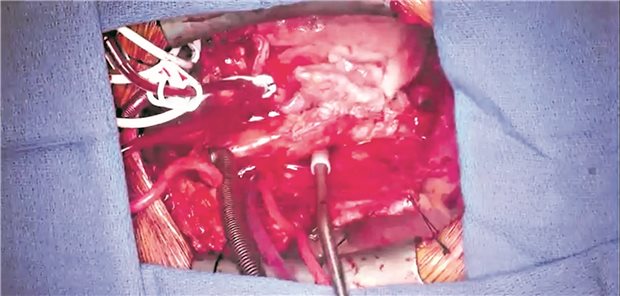 Patient mit Schweineherz: Fremdes Cytomegalovirus gefunden Sind zusammen mit dem Schweineherz auch nicht humane Cytomegaloviren in den Körper des Patienten gekommen? Untersuchungen scheinen das nahezulegen.
