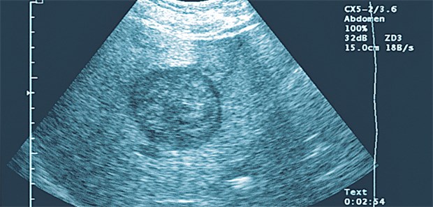 Singuläres hepatozelluläres Karzinom (HCC) im Sonografie-Bild. Welche Prognose hat der Patient?