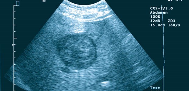 Endlich eine Leitlinie zu Leberkrebs Singuläres hepatozelluläres Karzinom (HCC) im Sonografie-Bild.