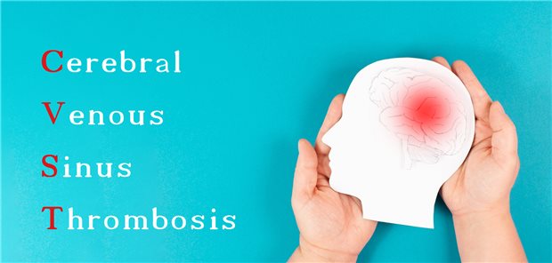 Sinusthrombose: Bei zehn bis 15 Prozent der Patientinnen und Patienten verläuft die Thrombose schwer. 