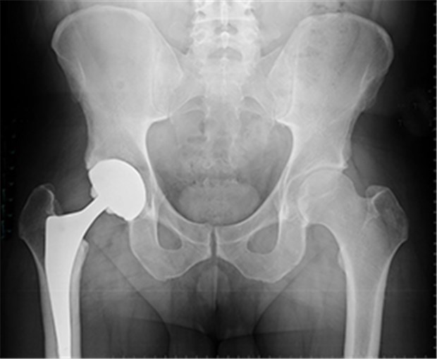 Krasse Unterschiede bei der Qualität in Kliniken Sitzt perfekt: ein künstliches Hüftgelenk. Aber es gibt Kliniken, in denen Komplikationen weit über dem Durchschnitt liegen.