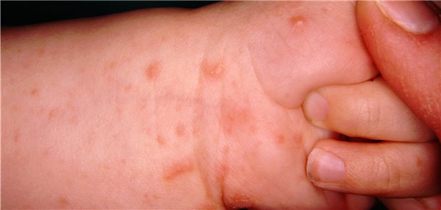 Skabies wird durch die Krätze-Milbe hervorgerufen, die nur den Menschen befällt, in die oberste Hautschicht tunnelförmige Gänge gräbt und dort dann Eier legt.