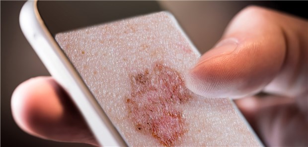 Smartphone-Apps zur Hautkrebs-Erkennung liefern bisher nur mäßige Ergebnisse.