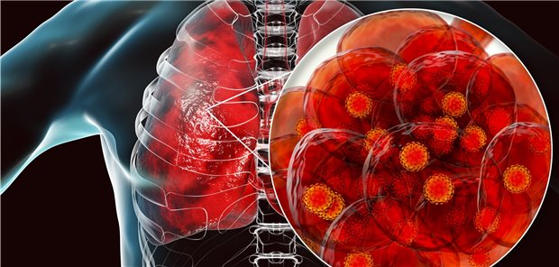 So beginnt COVID-19: SARS-CoV-2 in den Alveoli der Lunge.
