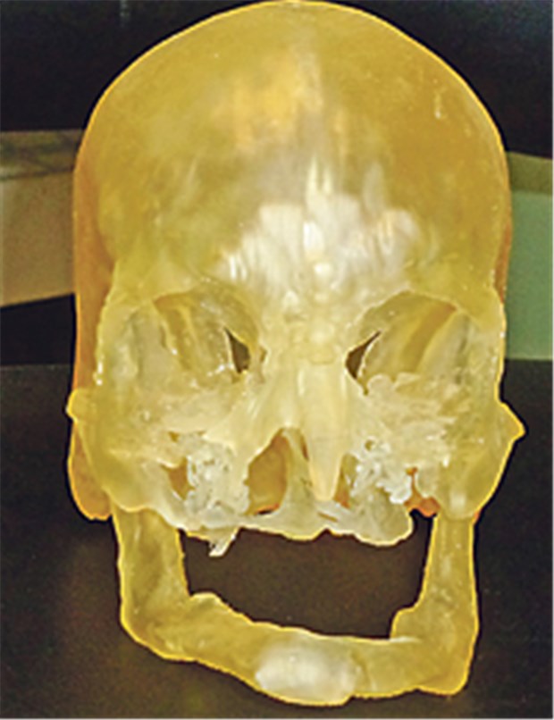 Schädel aus dem 3D-Drucker So kommt ein 3D-Schädelmodell aus dem Drucker. Die Daten werden aus Daten einer präoperativen Volumen-CT generiert.