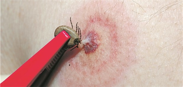 Erythema migrans verriet Ursache von AV-Block So nicht!: Die Pinzette sollte am Zeckenstachel greifen. In der Studie gab es nur die Hautmanifestation.