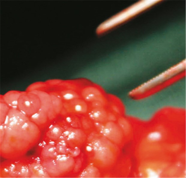 Ärztliche Kunst wird zum Kunstwerk So schön kann ein tubulovillöser Polyp in der Dickdarmschleimhaut sein: Ästhetische Op-Bilder zeigen Patienten ihre Einzigartigkeit.