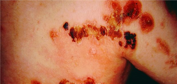 Kind mit Epidermolysis bullosa überlebt – dank genveränderter Haut aus Stammzellen