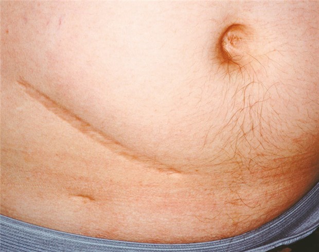 Neue Hinweise: Viren und Bakterien lösen Appendizitis aus Solch ausgeprägte Narben am Bauch sieht man heute nach Appendektomie dank laparoskopischer Op nur noch selten. © microimages / fotolia.de