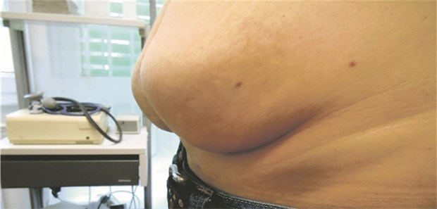 Mysteriöse Hypoglykämien: Ursache war eine Lipohypertrophie Solche Ausmaße können Lipohypertrophien bei insulinspritzenden Diabetikern einnehmen.