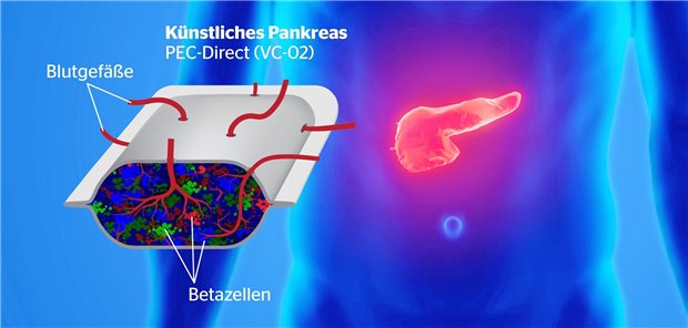 Solche Kapseln (von der Größe einer Scheckkarte) mit aus Stammzellen gewonnenen Betazellen wurden Patienten ohne residuelle Insulinproduktion subkutan implantiert.