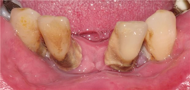 Schlechter Zustand von Zähnen.