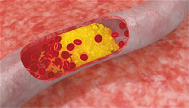 Solchen Cholesterin-Plaques beugt LDL-Senkung vor.