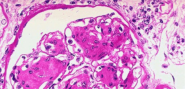 Sachsen bei Telemedizin in der Vorreiterrolle Soll auch von Telemedizin profitieren: Histologie (hier eine noduläre Glomerulosklerose).