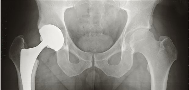 Sollen der Ausbau einer infizierten Hüftprothese und der Einbau eines neuen Gelenkersatzes in einem einzigen oder in zwei separaten Eingriffen erfolgen? In einer randomisierten Studie wurden die Ergebnisse aus Patientensicht verglichen.